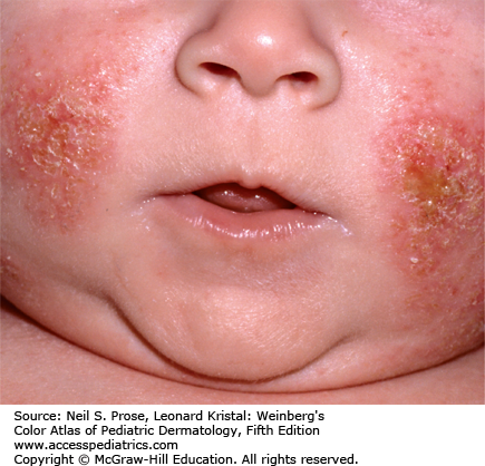Image result for atopic dermatitis